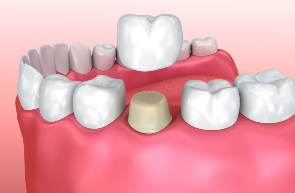 A 3D image of gums and teeth and dental crown replacement.
